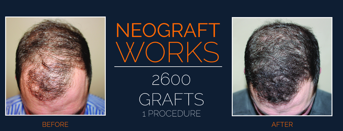 Neograft Hair Transplants