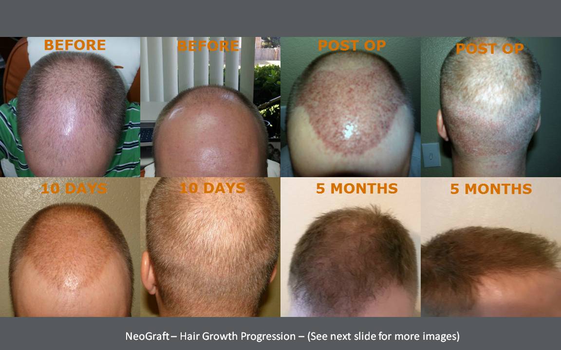 Neograft Hair Transplants