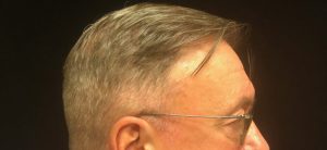 Dr. Slack's Neograft