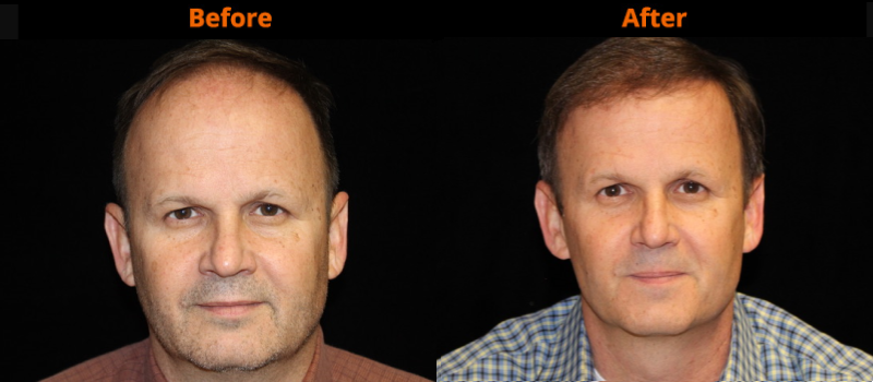 Dr. Slack’s patients receiving Neograft treatment.