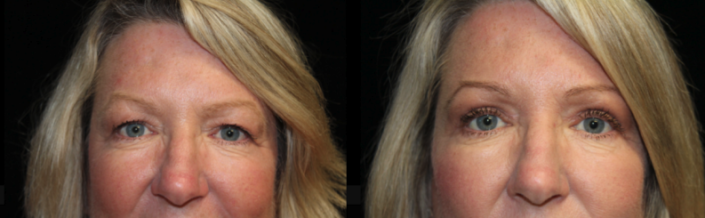 Eyelid Surgery