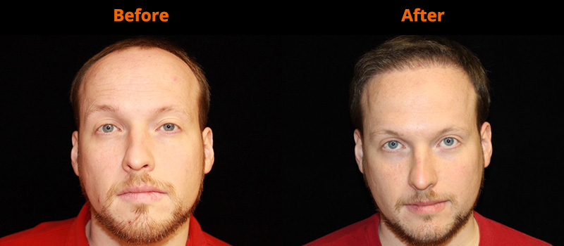 Dr. Slack’s patients receiving Neograft treatment.