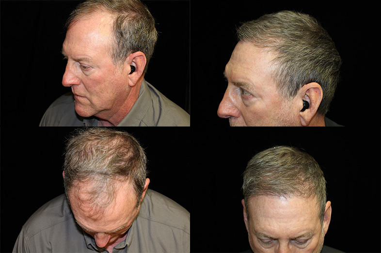 Before and After - Neograft