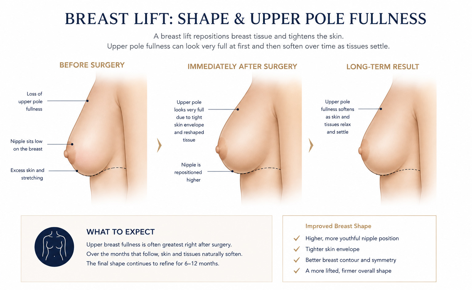 Illustration showing breast lift shape and upper pole fullness